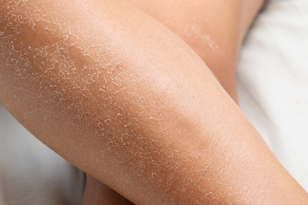 Dry Skin vs Dehydrated Skin: What You Should Know