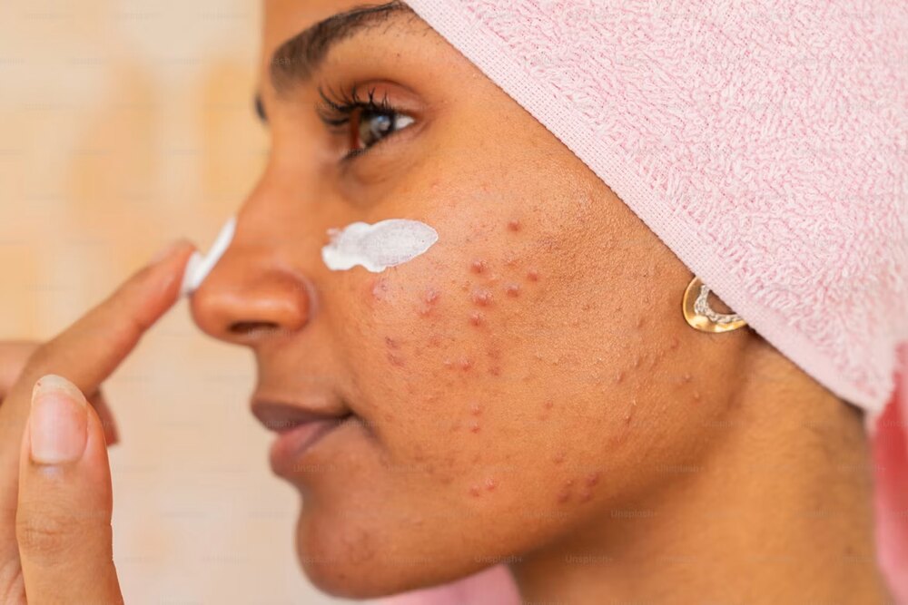 Woman applying skincare cream to blemished cheek, preventing pimples
