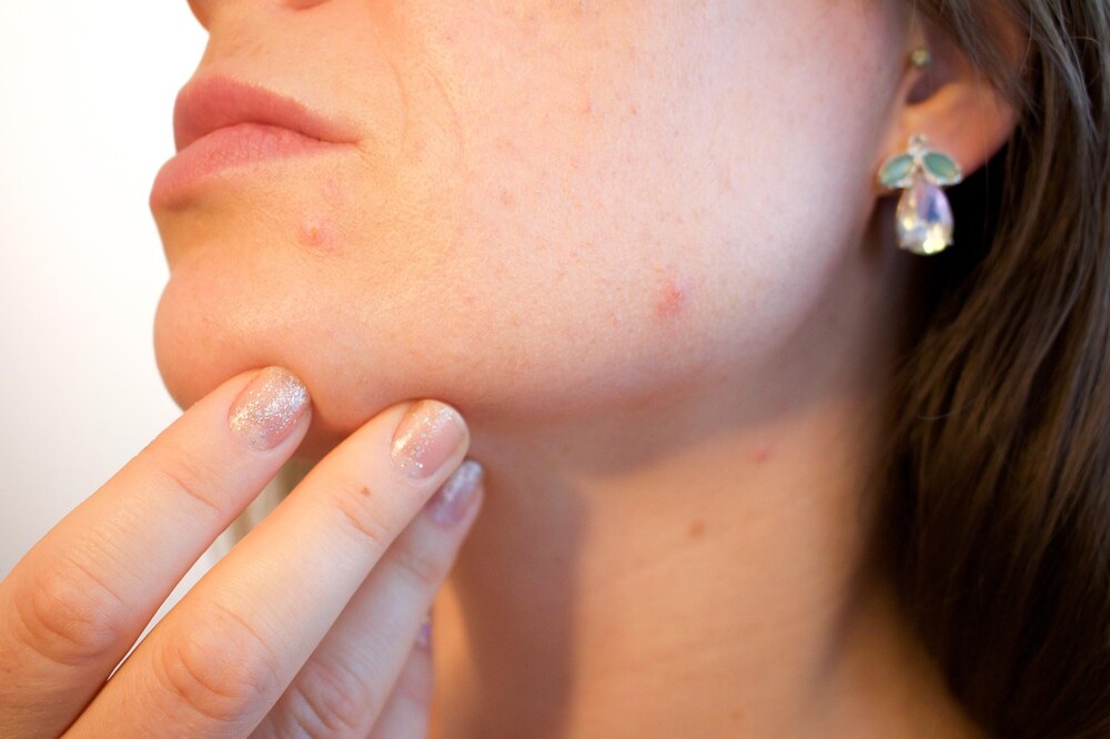 Close-up of a woman touching small pimples, learning what causes pimples
