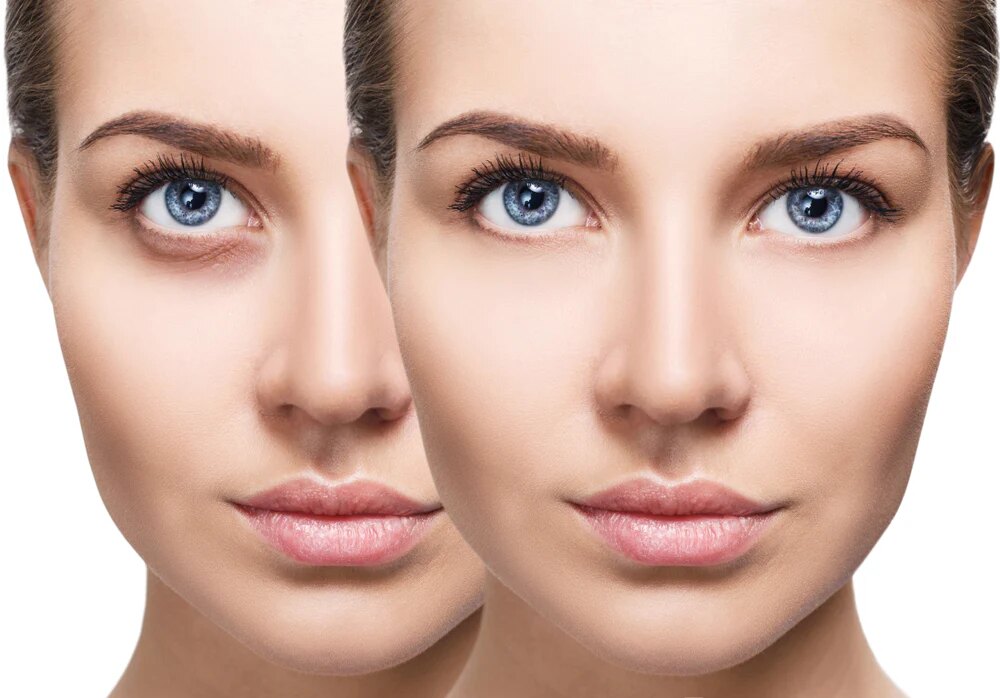 Two images of a woman’s face—one with dark under-eye circles and one without