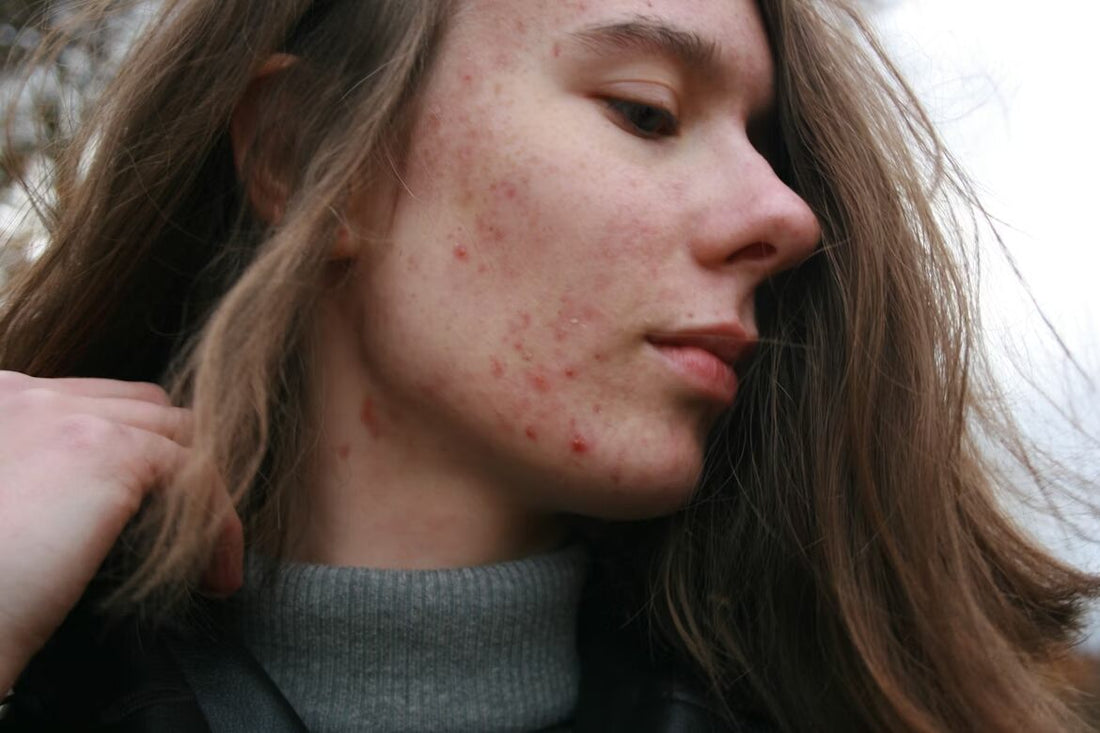 A woman with pimples on her cheek