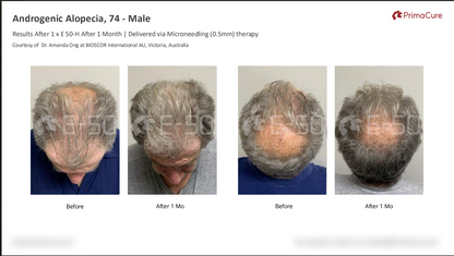 Before and after images of Androgenic Alopecia treatment with PrimaCure.